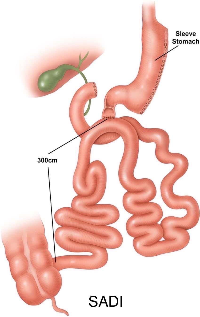 Diagram of the completed SADI-S operation: the sleeve stomach, the duodenum divided just past the pylorus with the bypassed duodenum continuing into the jejunum, a loop of ileum joined to the duodenal stump, and a 300 cm common channel running to the caecum.