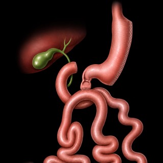 A completed SADI-S: the sleeve stomach, the duodenum divided just past the pylorus, and the single loop connection to the ileum